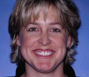 Lisa before extreme dental makeover